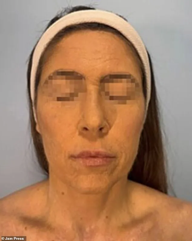 Rare Lamotrigine Reaction Leaves Woman with Severe Facial Burns, Scarring